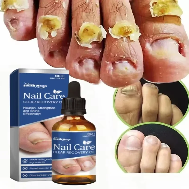 Fungal Nail Repair Drops Infection Nail Removal Anti Paronychia Improve Broken Cracked Discolored Toenail Renewal Care Essence