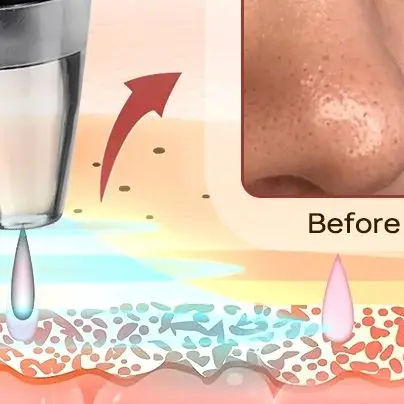 Elektryczny odkurzacz do wągrów, urządzenie do usuwania trądziku i czarnych kropek, głębokie oczyszczanie twarzy, urządzenie do czyszczenia porów, narzędzia do pielęgnacji skóry.