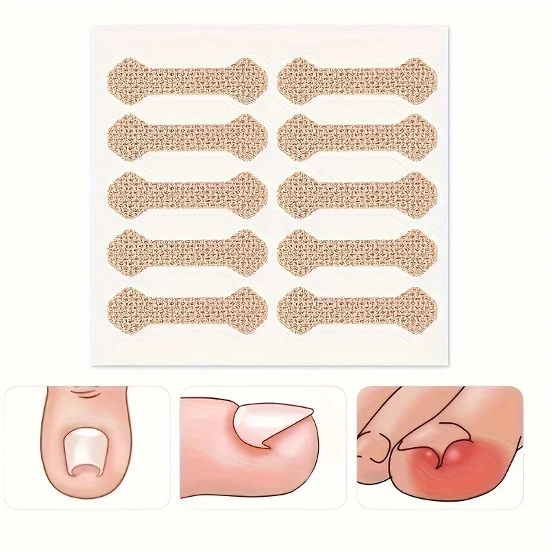 Bandes correctrices d'ongles incarnés Paronychia, Anti F, 10 pièces, bandes correctrices d'ongles incarnés, Anti F, vente en gros