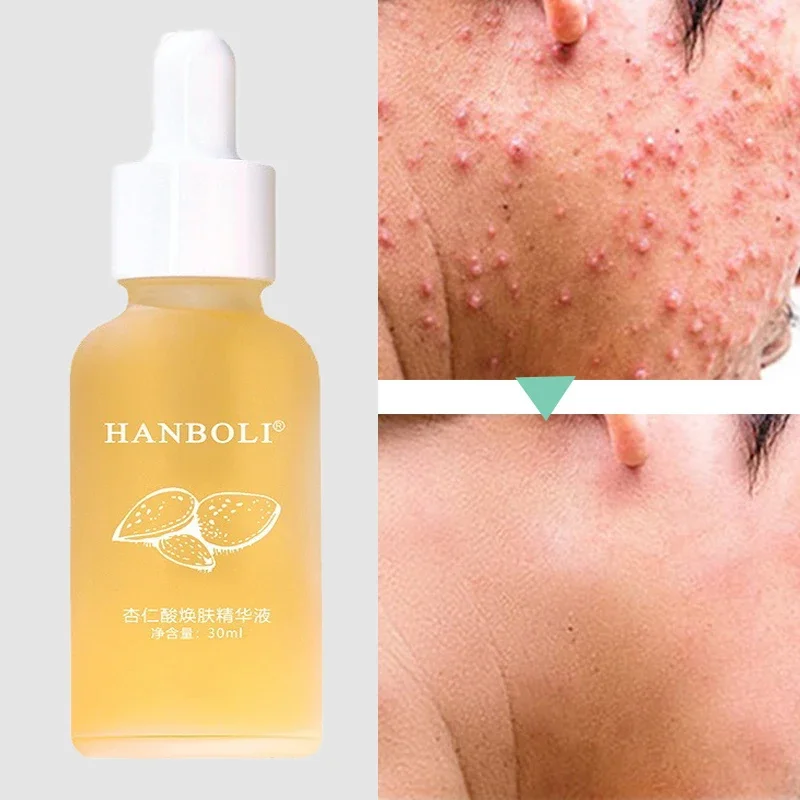 Acne Removal Serum Shrink Pores Tighten Skin Removal Acne Spots Moisturizing Whitening Acne Solution Repair Serum Skin Care 30ml