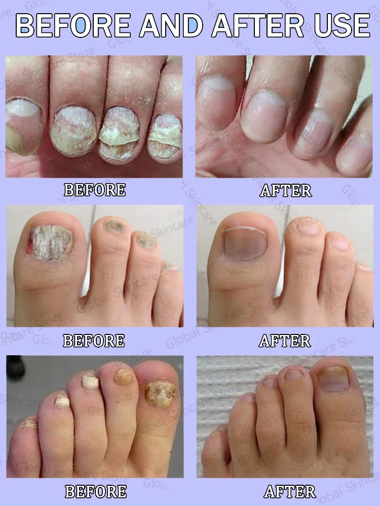 ERASE Onicomicosis FOREVER! Recurrencia ZERO NO daños en las uñas: ¡MATAR los hongos en 7 días, 99,3% tasa de SUCCESS!