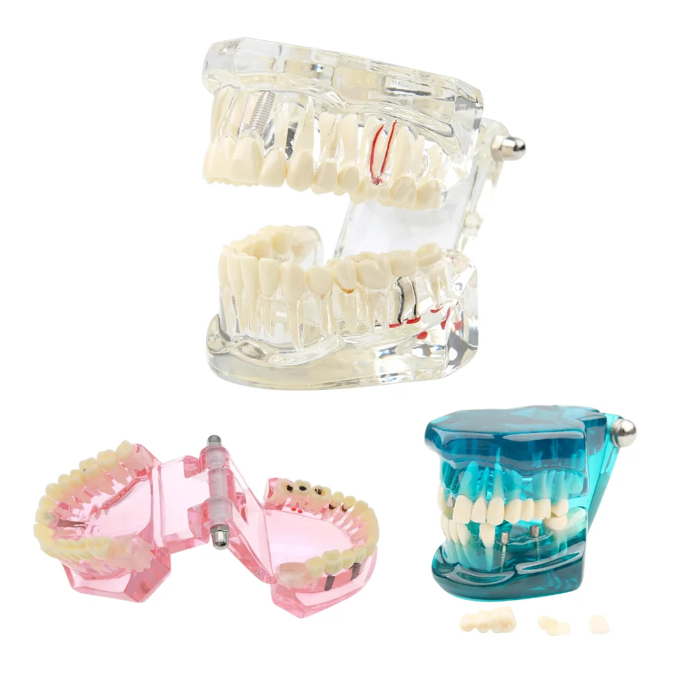 Dental Transparent Disease Teeth Model Implant Teeth Model Removable Crown Bridge Analysis Demonstration Student Education Train