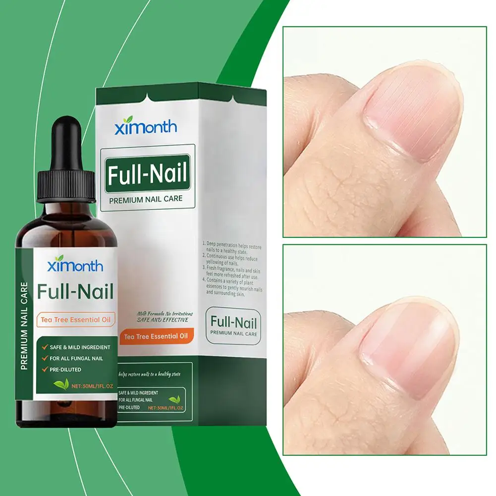 Tratamento de fungos nas unhas dos pés, óleo essencial de árvore de chá para unhas danificadas e descoloridas, fungos nas unhas, cuidados com onicomicose sol g0d3