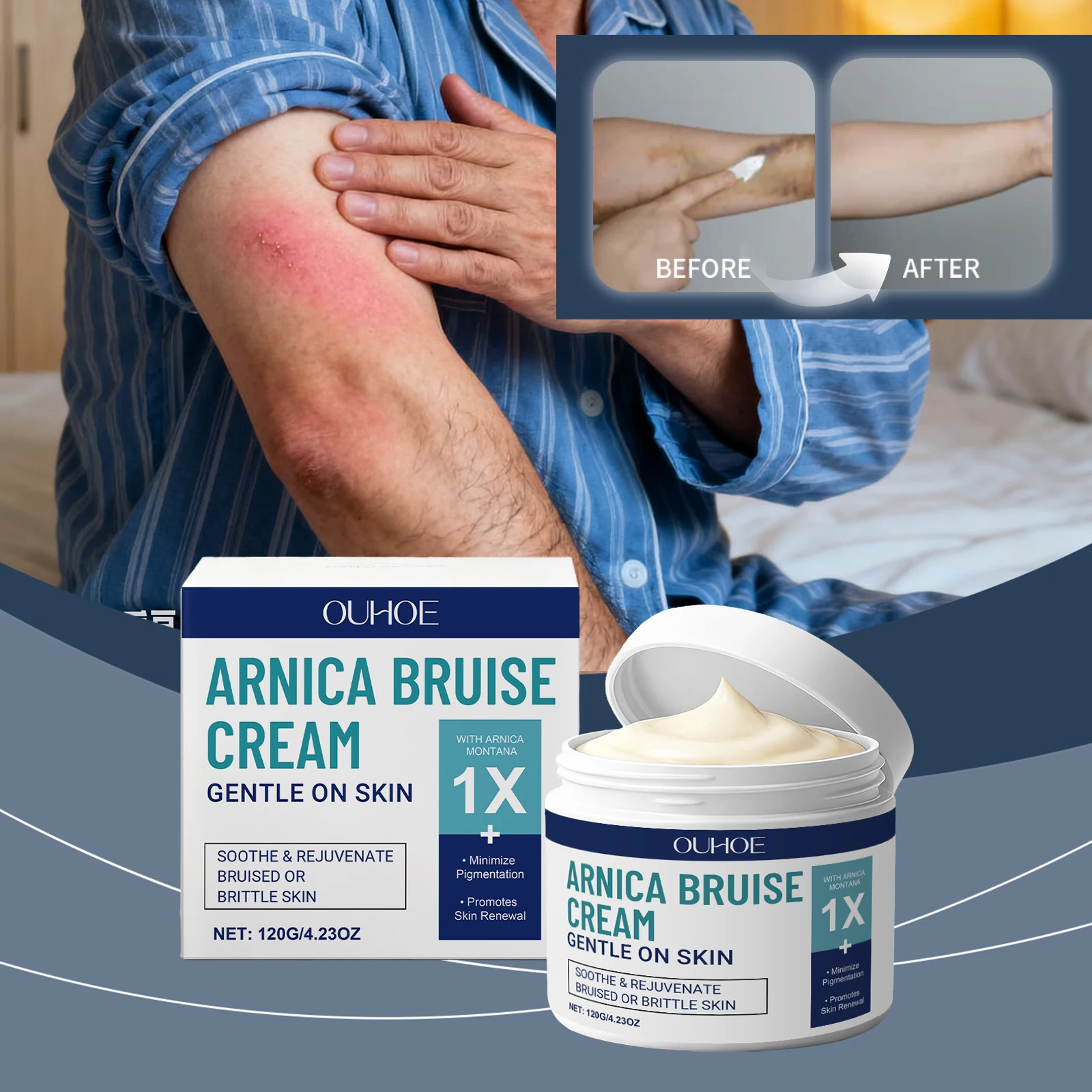 OUHOE Arnica Bruise Cream Repairs Bruises Improves Hyperpigmentation Gentle Formula Applies Easily Absorbs Quickly