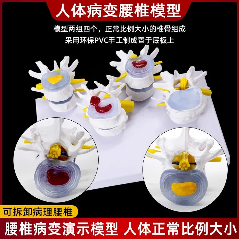Lumbar Spine Structure Display Model Teaching Demonstration Accessory