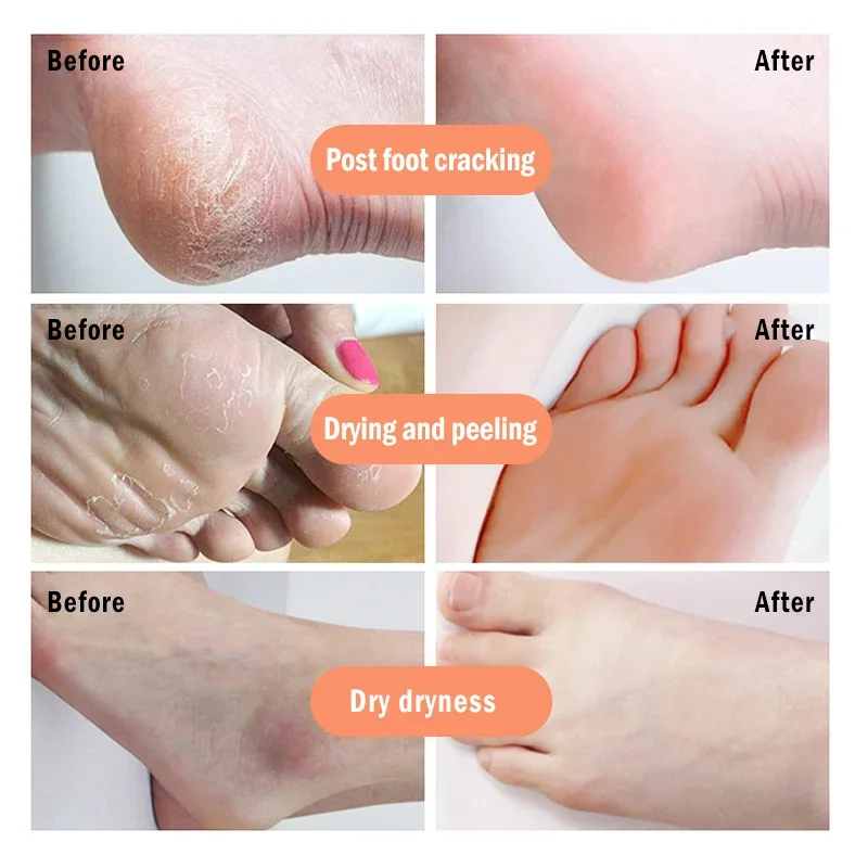 Anti-Drying Crack Foot Cream Heel Cracked Repair Cream Banana Oli Moisturizing Removal Dead Skin Hand Feet Smooth Care 각질제거