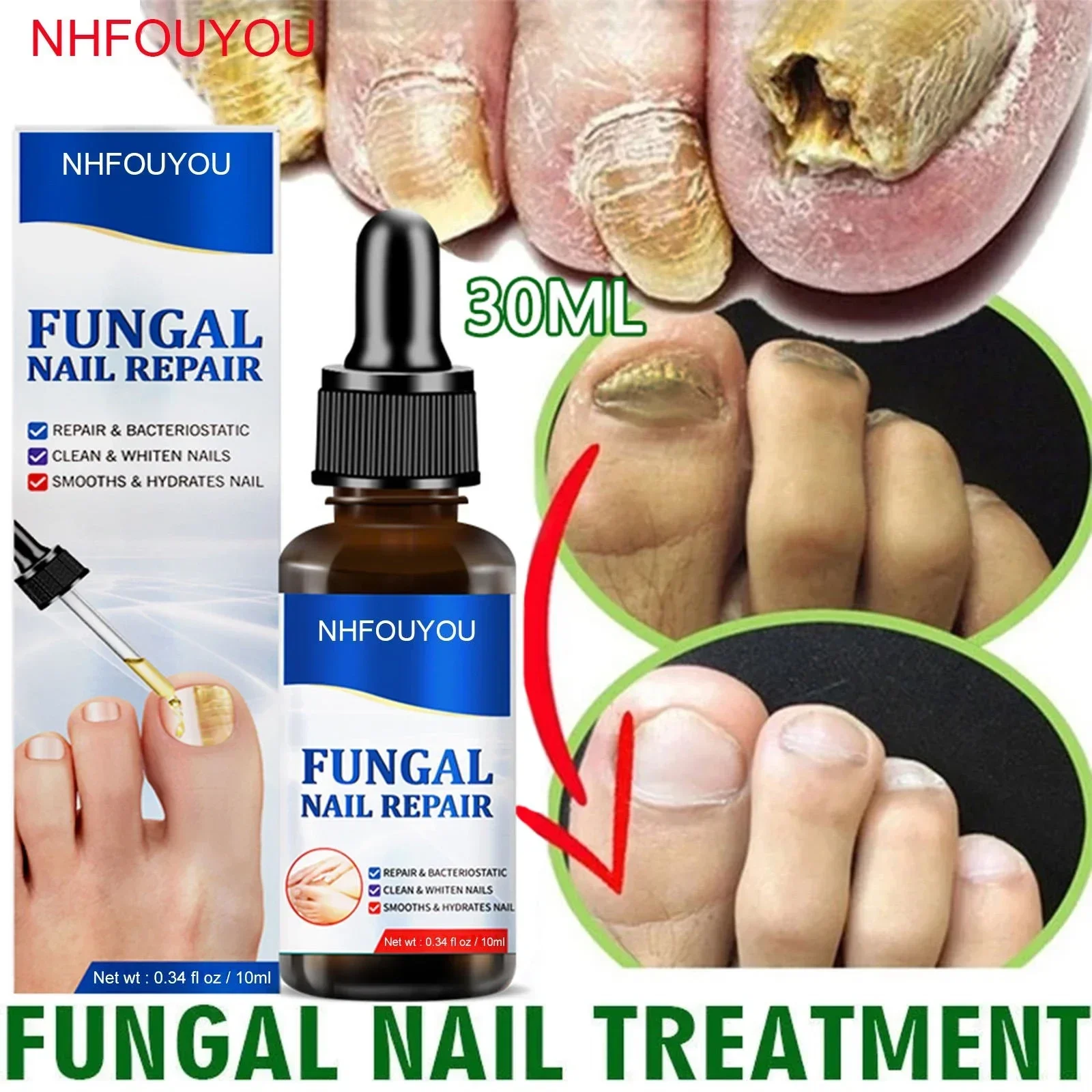 Óleo Fungal Tratamento Unhas, Essência Reparação Pé, Toe Nail Fungus Remoção Gel, Creme Anti Infecção, 10ml