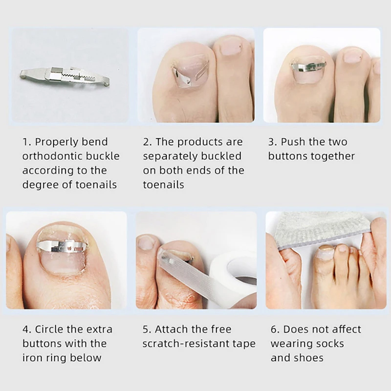 Ingrown Toenail Corrector Tools Pedicure Recover Embed Toe Nail Treatment Professional Ingrown Toenail Correction Foot Care Tool