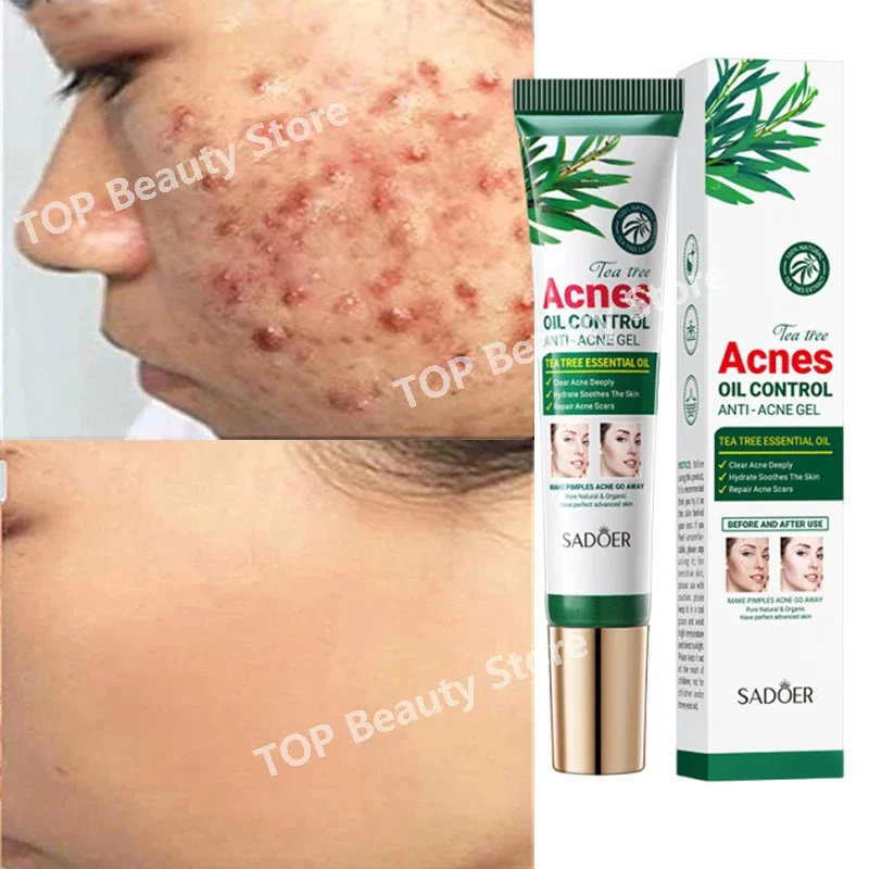 Tea Tree Acne Removing Cream Facial Mild Moisturizing Oil Control Acne Removing Facial Gel Eliminate Acne Pimples Beauty Health