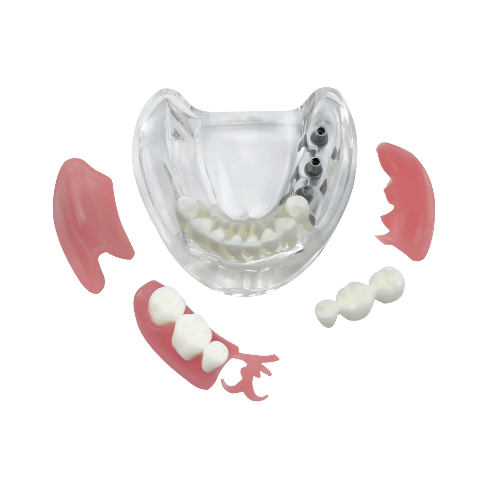 Dental Teeth Model With 3 Implants Restoration Bridge Typodont M6006 Overdenture Inferior Demo Mandibular Model Teaching Study