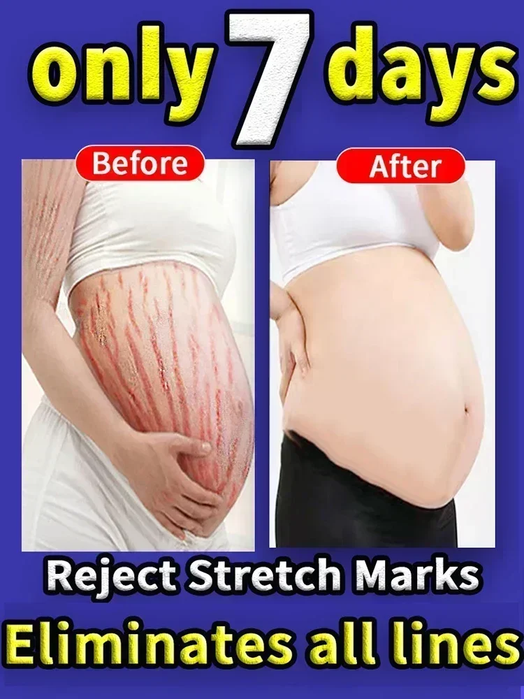 

7 Days Stretch Marks Spray For Pregnancy Remove Postpartum Obesity Women Scar Without Side Effect Butt Firm Lift Skin Body Cream