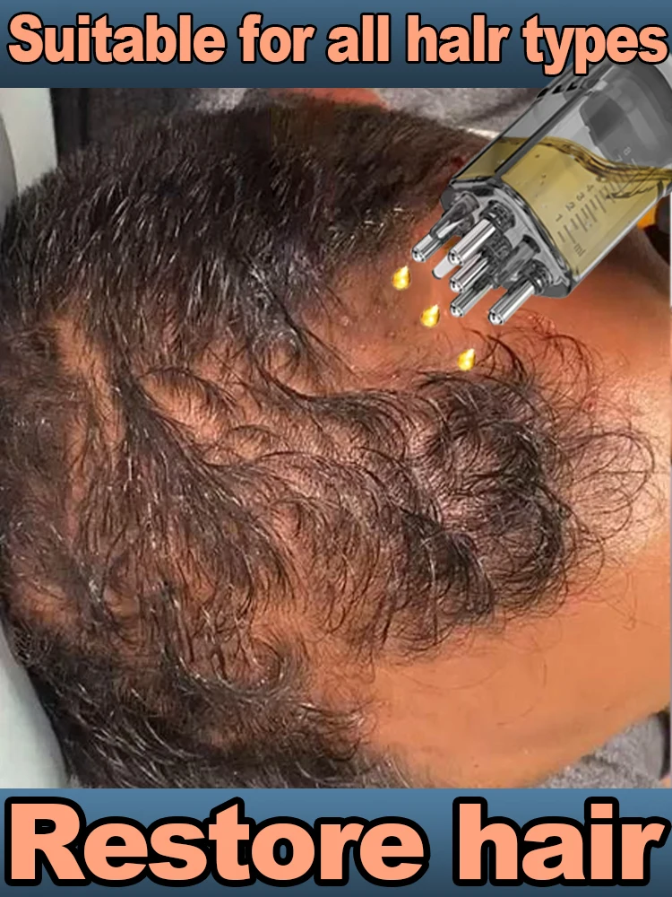 

Generation-2 Yellow Essence Says Goodbye To Hair Lose In 7 Days
