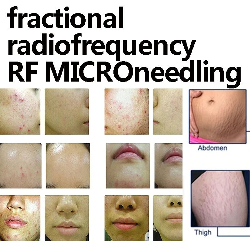 

Multi Functional Radio Frequency Skin Rejuvenation Skin Tightening Facial Beauty Machine