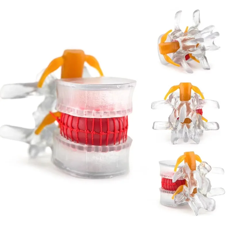 Transparent Intervertebral Disc Protrusion Model -1.5 Times Human Size Lumbar Disc Protrusion Model Learning and Teaching Tool