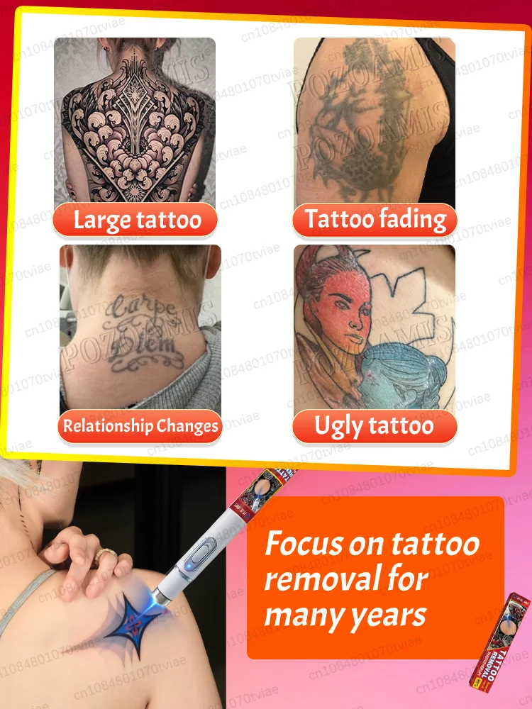 Rimozione del tatuaggio e rimozione del colore