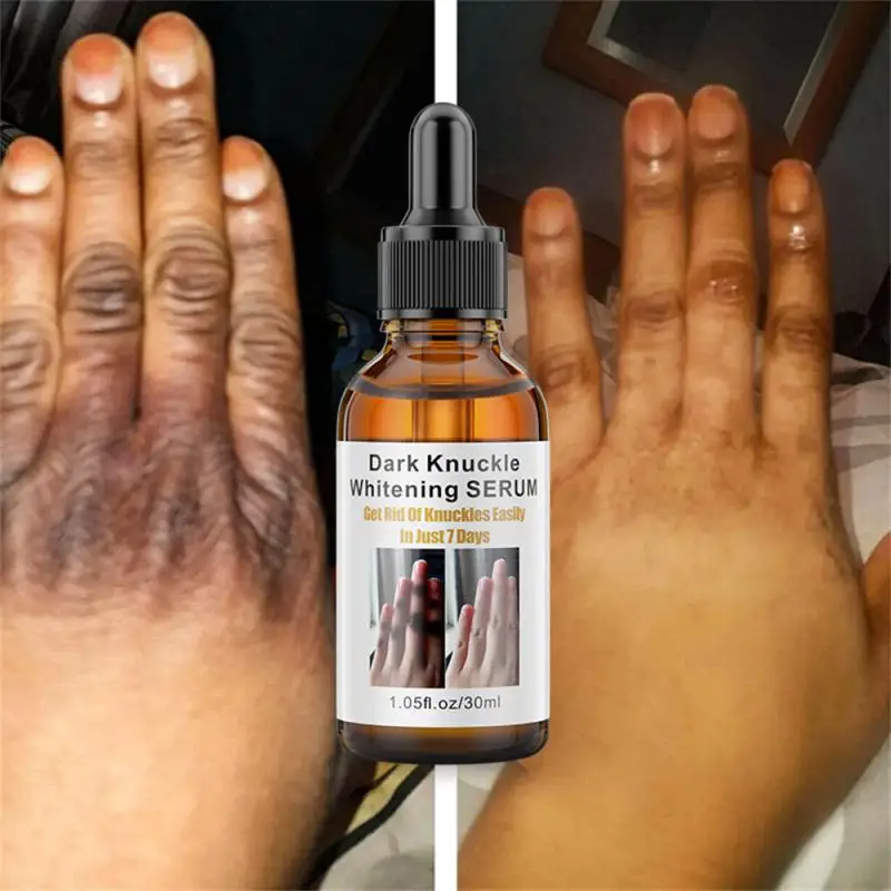 Dark Knuckles Soro de clareamento rápido, pigmentação correctores para pele negra, mão, cotovelos, joelho, removedor de manchas intensas