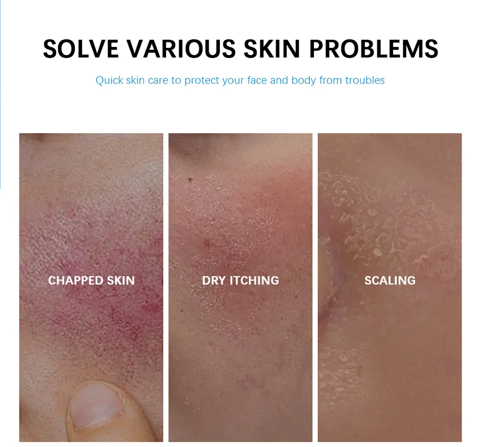 B5 Reduce Facial Redness Cream Instant Spider Vein Remove Sensitive Skin Sooth Anti Redness Rosacea Treat Lotion Korean Cosmetic