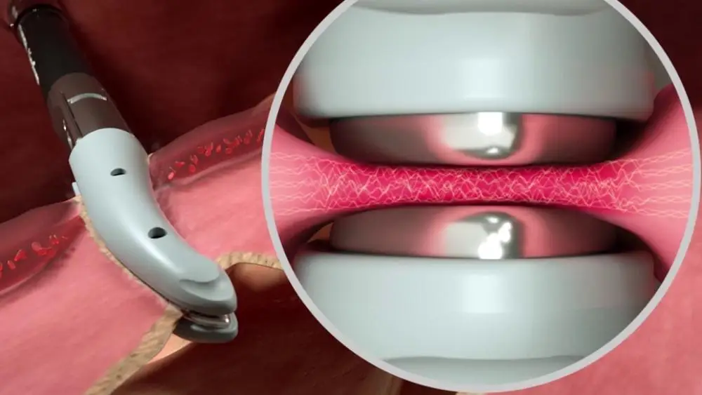 Valley lab Ligasure Instrument für die Laparoskopie