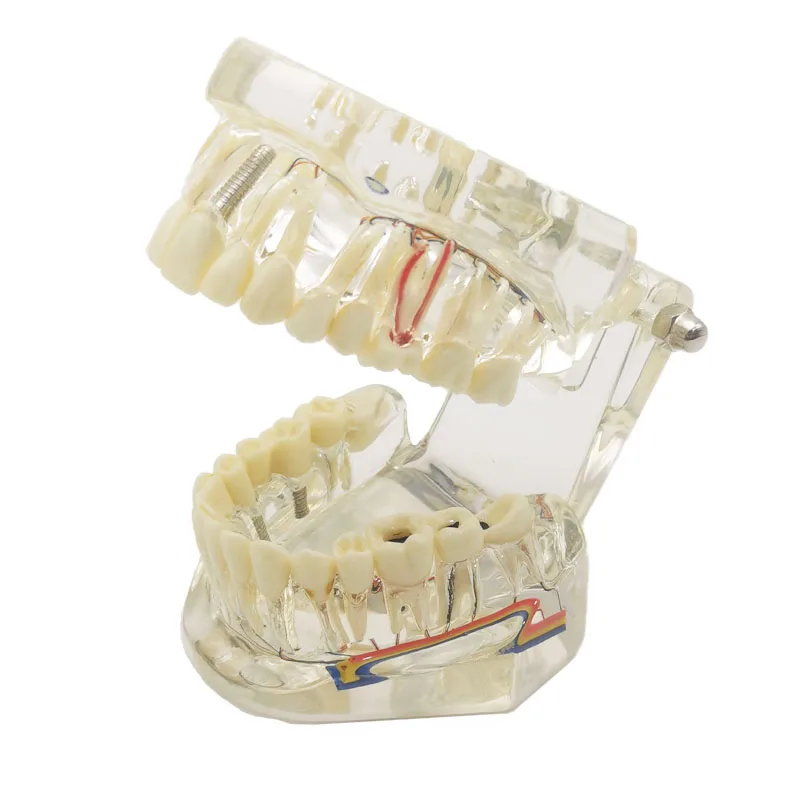 Dental Implant Model Teeth Neural Repair Resin Models Of Diseased Teeth for Dentist  Teaching and Research In Dental Diseases