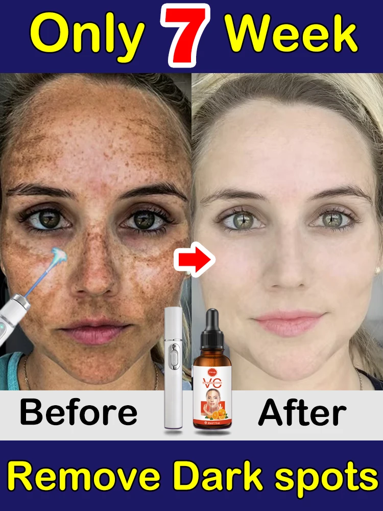 Dark Spots Remover Cream Freckles Melasma SunAge Spot