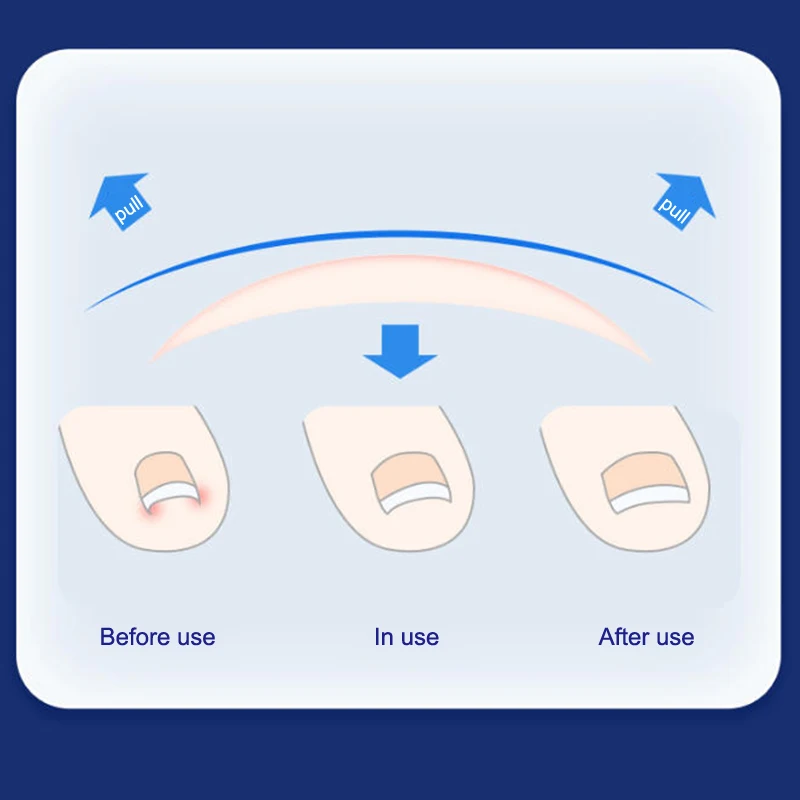 10Pcs Ingrown Toenail Treatment Kit With 4 Multi-Sizes,Titanium Alloy Ingrown Nail Corrector Tools For Curved Toenail Corrector