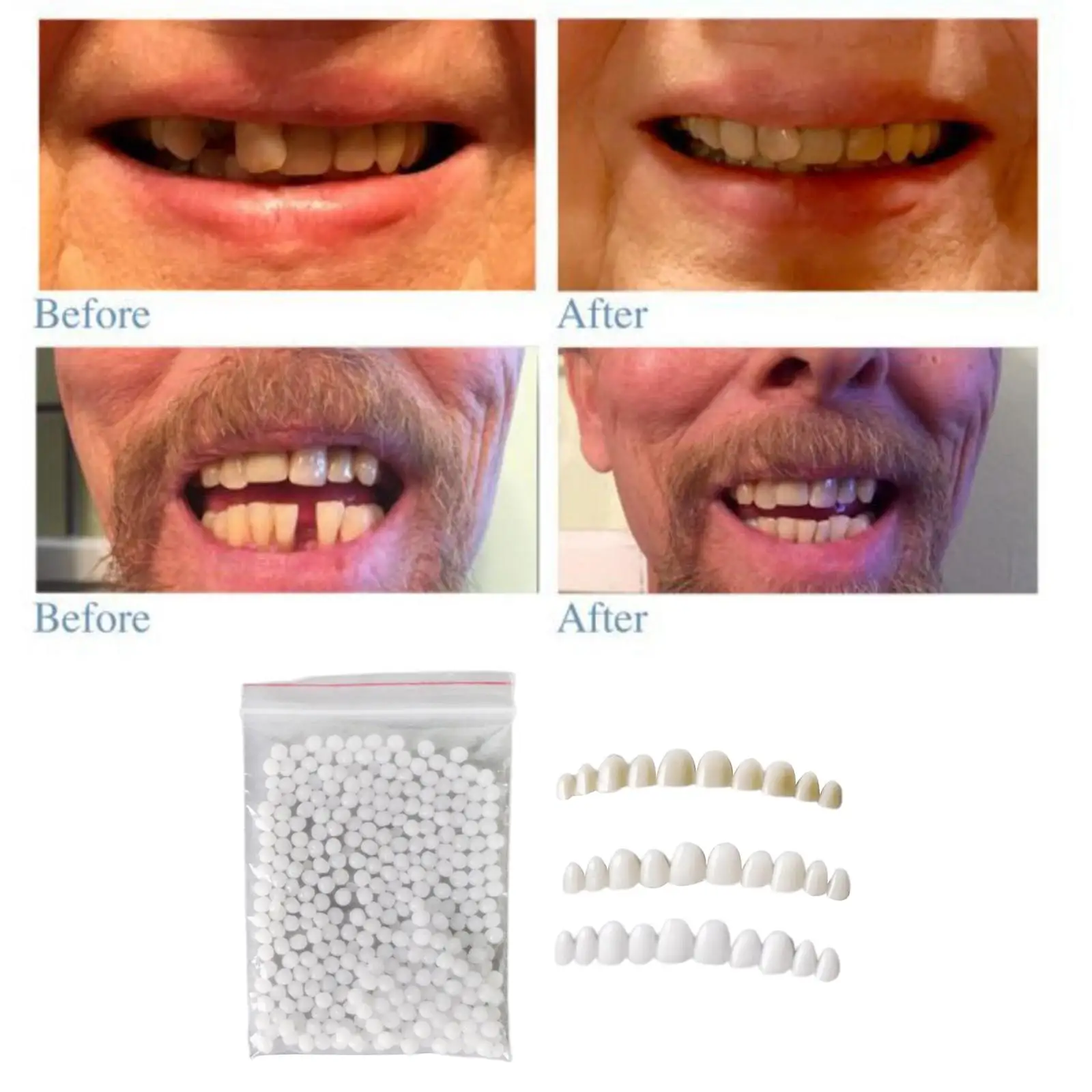 3X Silicone Veneers with Fitting Beads Temporary Confidence