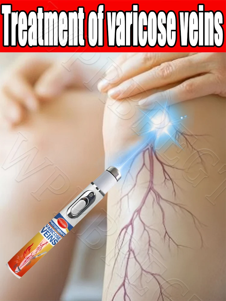 Verabschieden Sie sich von Krampfadern
