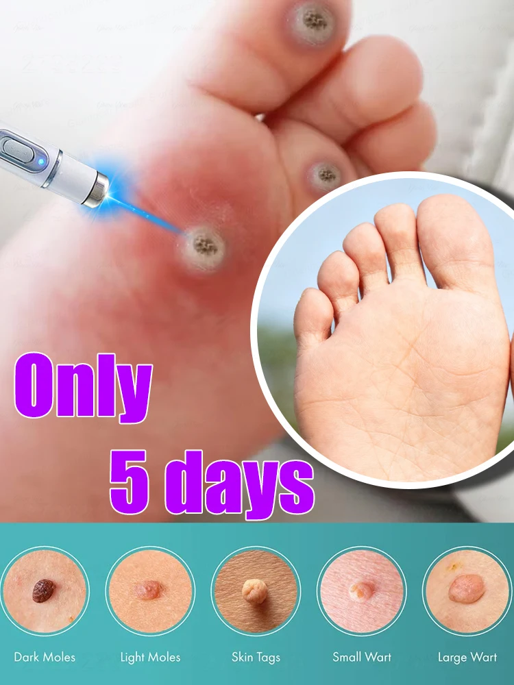 

Say Goodbye To Warts IN 7 Days