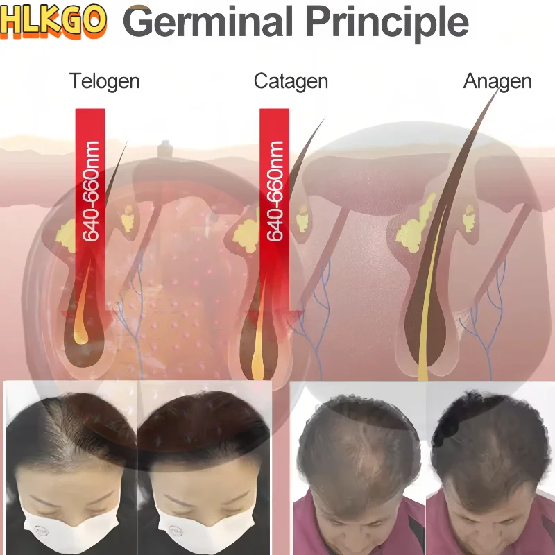 

2025 Upgrade Laser Hair Growth Cap 96 Strong Medical Lasers for Maximum Coverage Hair Restoration Men & Women