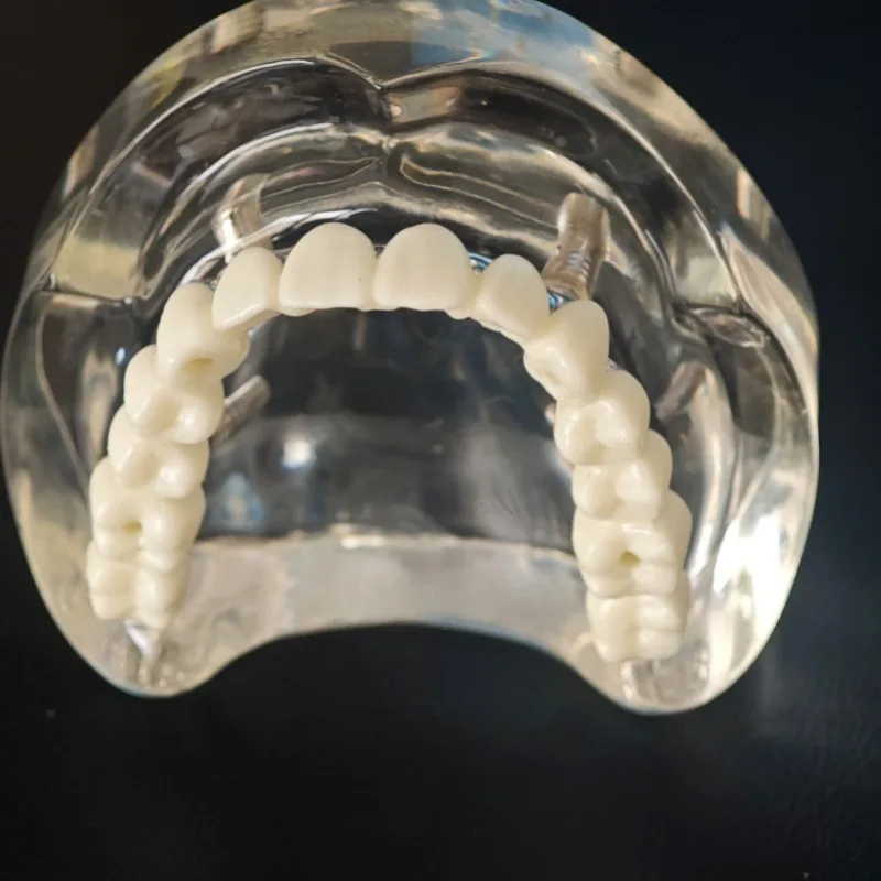 All-on-4 Lab Model | Implant Supported Bridge | Full Arch Teeth Replacement | Adjustable Resin Material