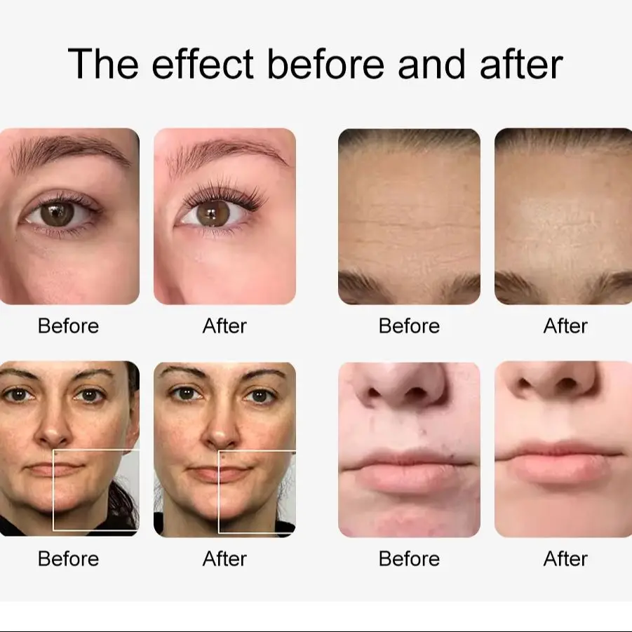 YUET WIN 10w1 Hydrodermabrazja Urządzenie do Głębokiego Oczyszczania Twarzy Liftingu Oczu Spray Wodny z Tlenem Pielęgnacja Skóry Bubble SPA Urządzenie Kosmetyczne