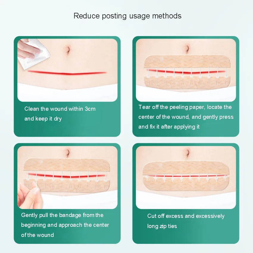 탄성 붕대 피부 봉합 장치, 지퍼 타입 상처 패치, 장력 감소 장치, 수술 후 심리스 패치