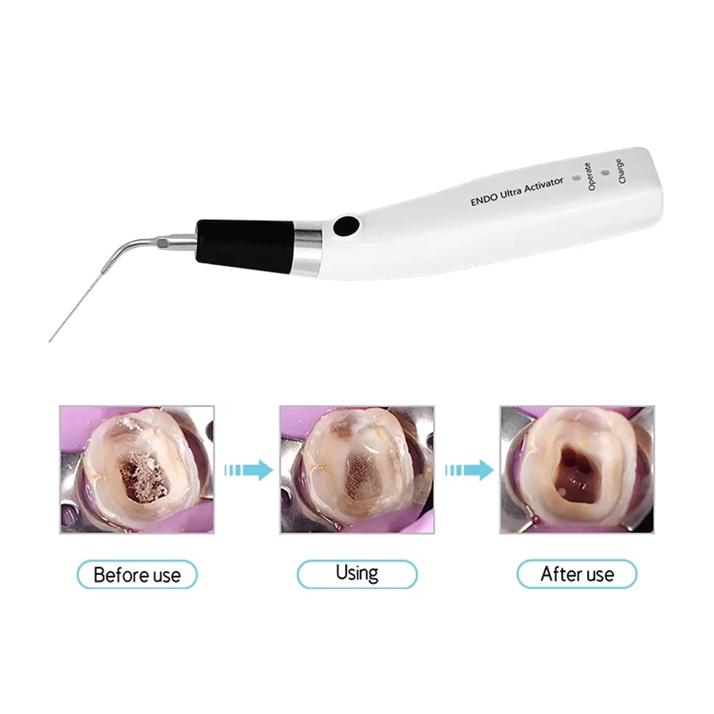 Sonic Irrigator Tips Endo Activator For Dental Instrument Root Canal Sonic Irrigator Endodontic Tools with 6 Tips 40-50Khz