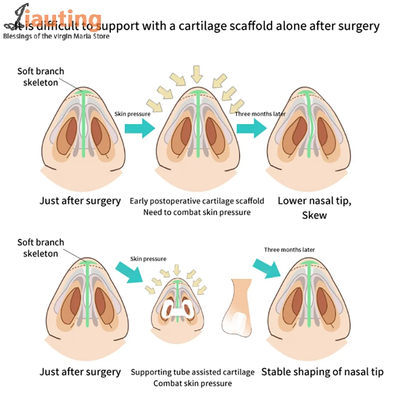 Nostril Support Device Postoperative Rhinoplasty Nostril Support Shaping Crooked Nose Correction Fixator Silica Gel Nose Clip