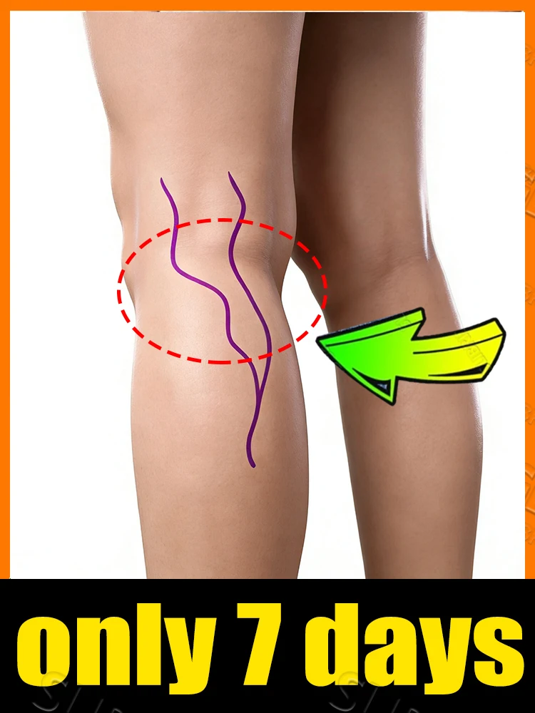 2025 بائعًا ساخنًا: قل وداعًا للساقين العنكبوتية خلال 7 أيام #1