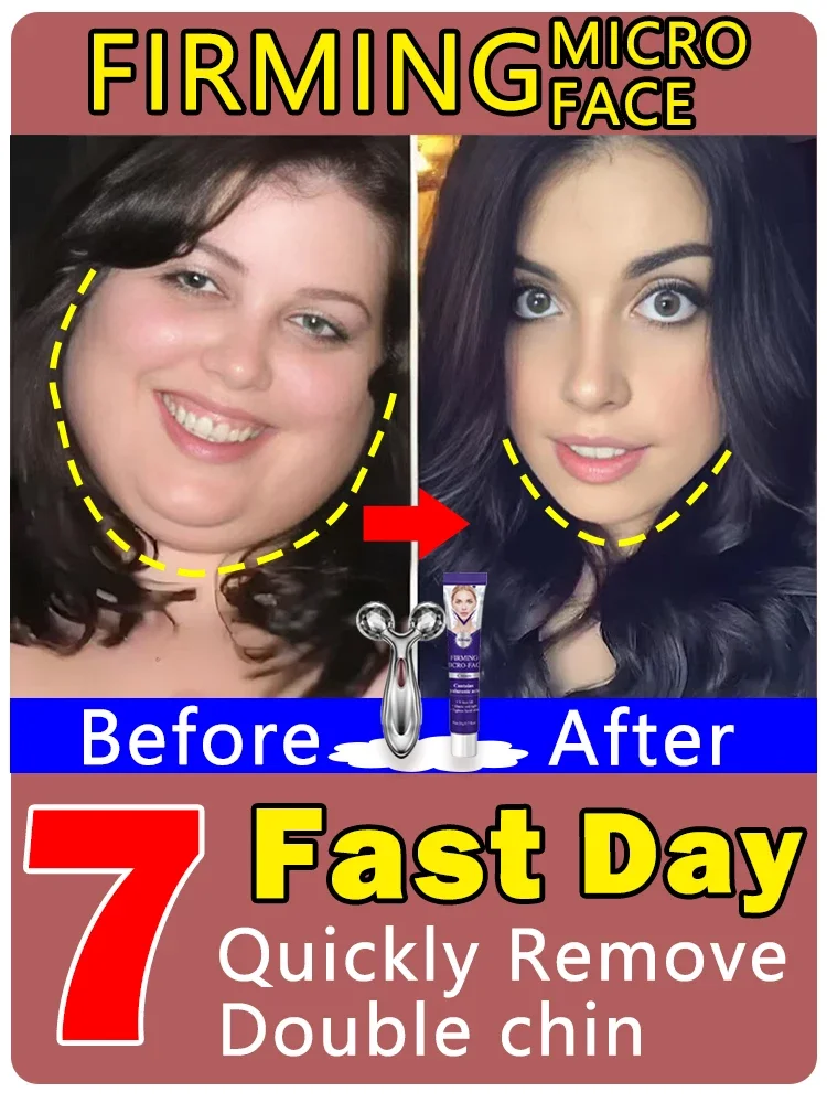 Fat removal for double chin and V-shaped face