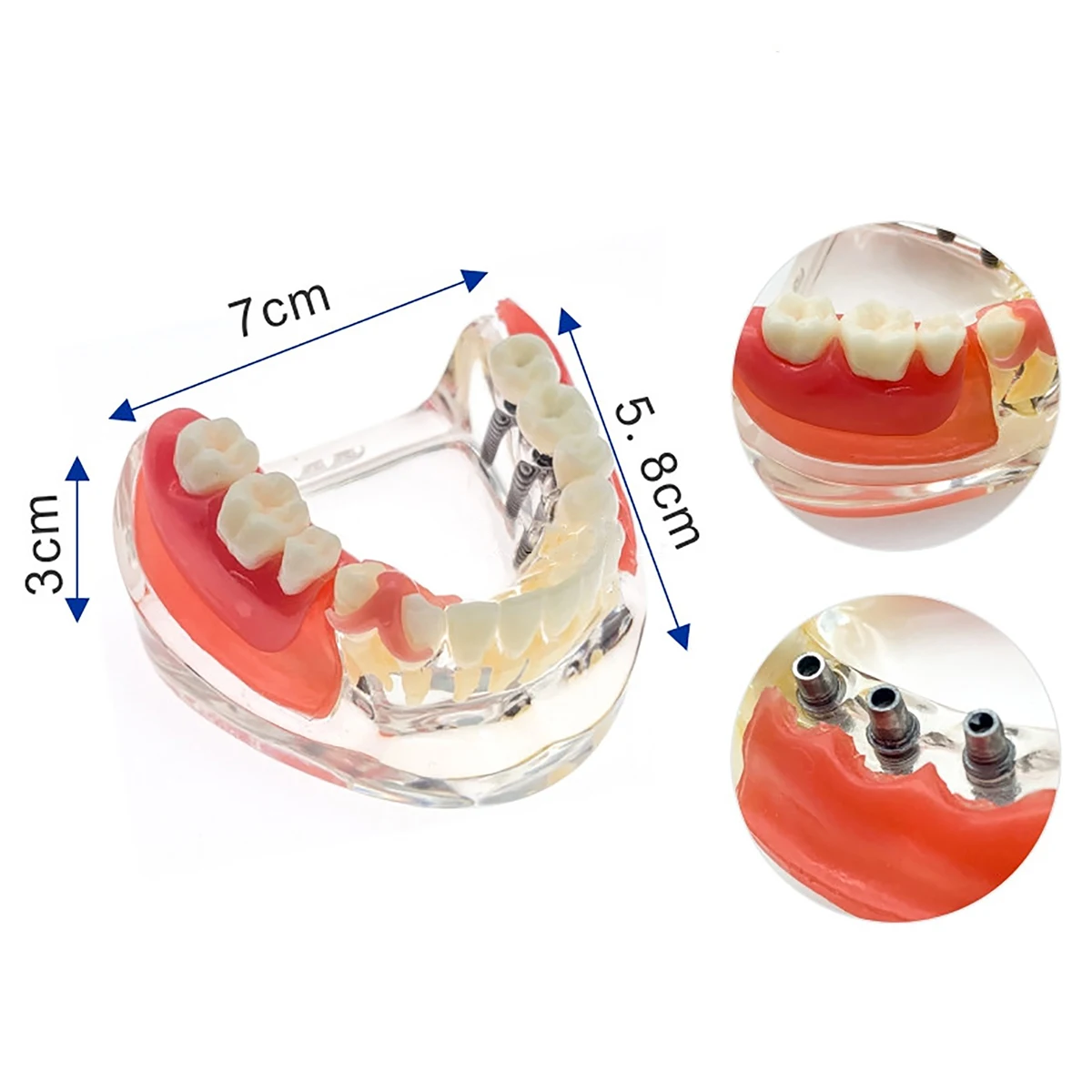 Dental Model Teeth Implant Restoration Dental Prosthesis Model   For Dentist Patient Communication Treatment Study Demo