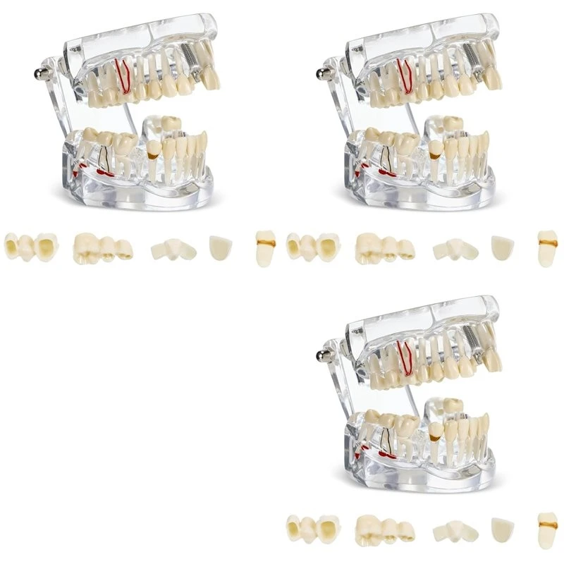 Modèle dentaire A73U 3X avec dents malades, typodontes, modèle d'implants dentaires avec dents amovibles, démonstration dentaire