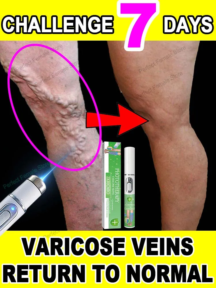 Varicose Veins Products