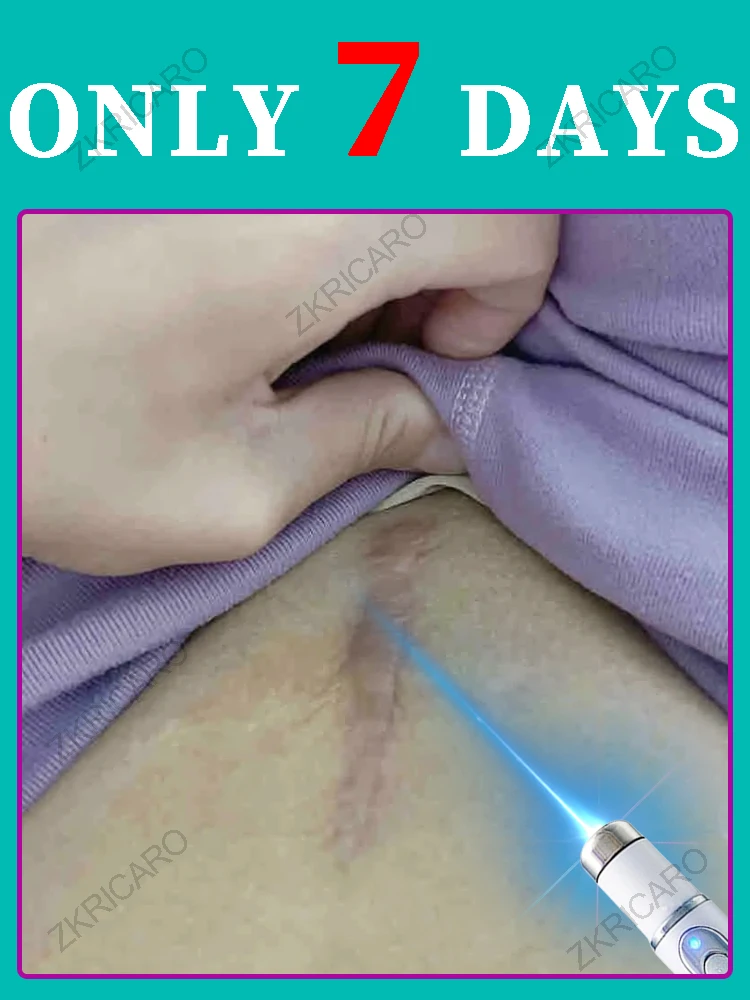 

Популярный инструмент для ухода за шрамами, быстро восстанавливает вашей кожи.