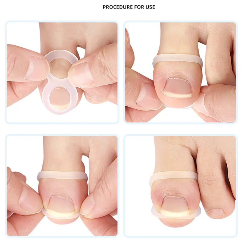 5Pcs Silicone Ingrown Toenail Correction Tool Invisible Ingrown Toe Nail Treatment Elastic Straightening Clip Brace Pedicure