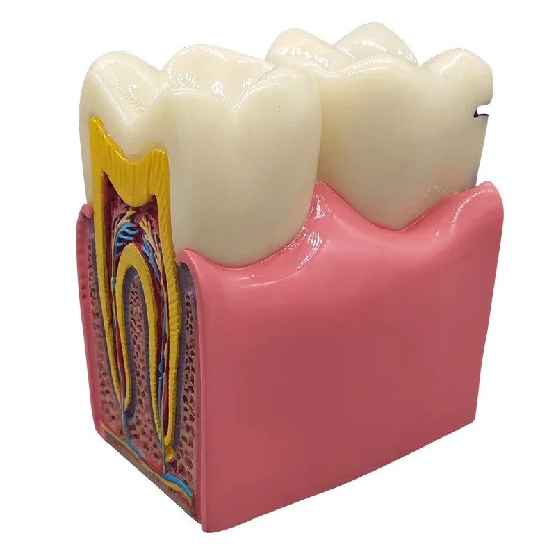 8 Times Dental Caries Model Disease Teeth Dental Model for Dental Demonstration Model Dentist Teaching Dental Lab Oral Research