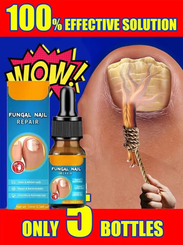 Fast Nail Fungal Treatments Nail Repair Essences Serum Care Treatments Foot Nail Fungus Removal Gel Paronychia Onychomycosis