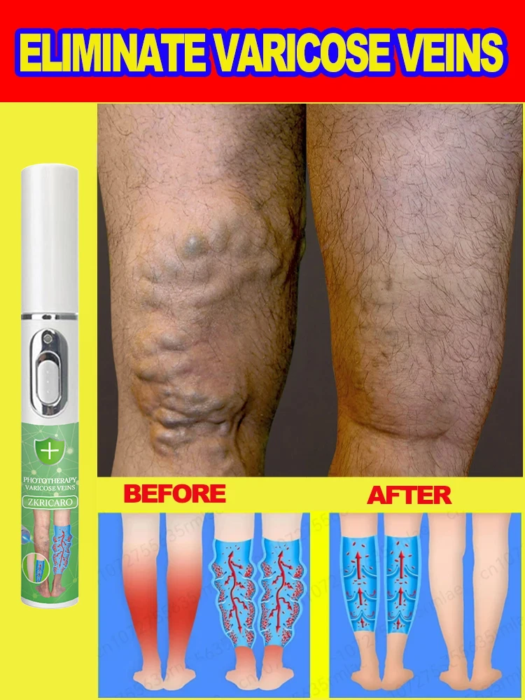 Say goodbye to varicose veins