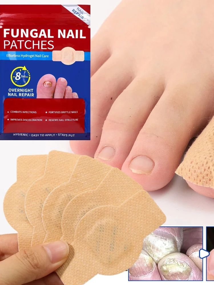 21 stks Waterdichte Nagel Schimmel Patch Ingegroeide Teennagel Correctie Sticker Beschadigd Grijs Nagel Reparatie Zorg Voeten Gereedschap - afbeelding 2
