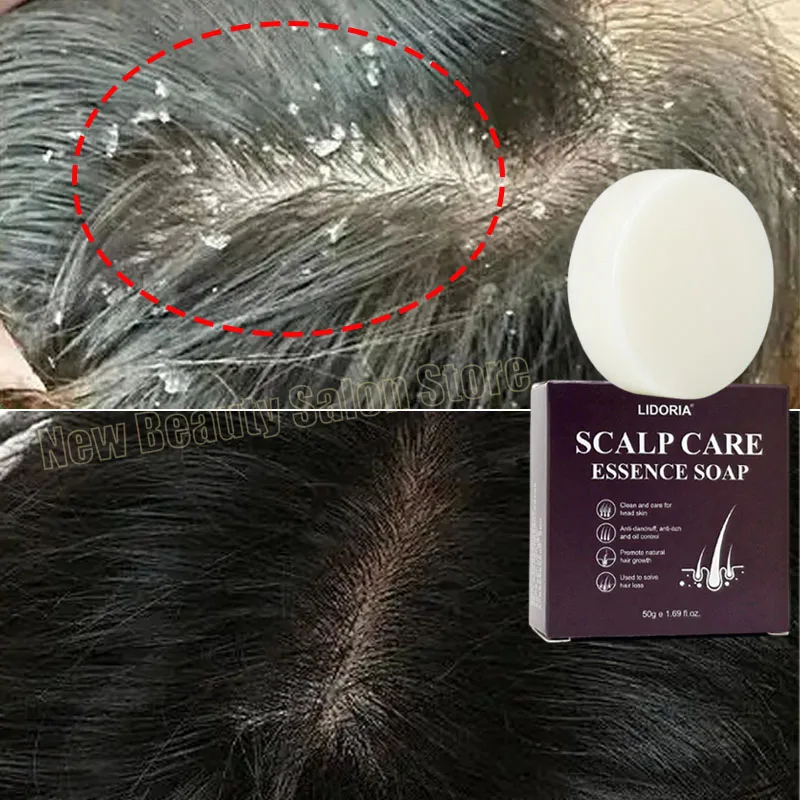 

Fast Remove Dandruff Hair Soap Anti Itching Treatment Seborrheic Scalp Oil Control Cleansing Repair Health Care Product 50g