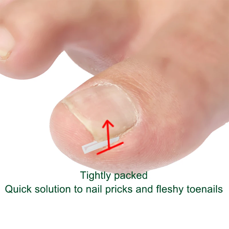 10/20/30/40/50/60Pcs Ingrown Toenail Corrector Elastic Patch Sticker Straightening Clip Brace With Nail Remover Pedicure Tools