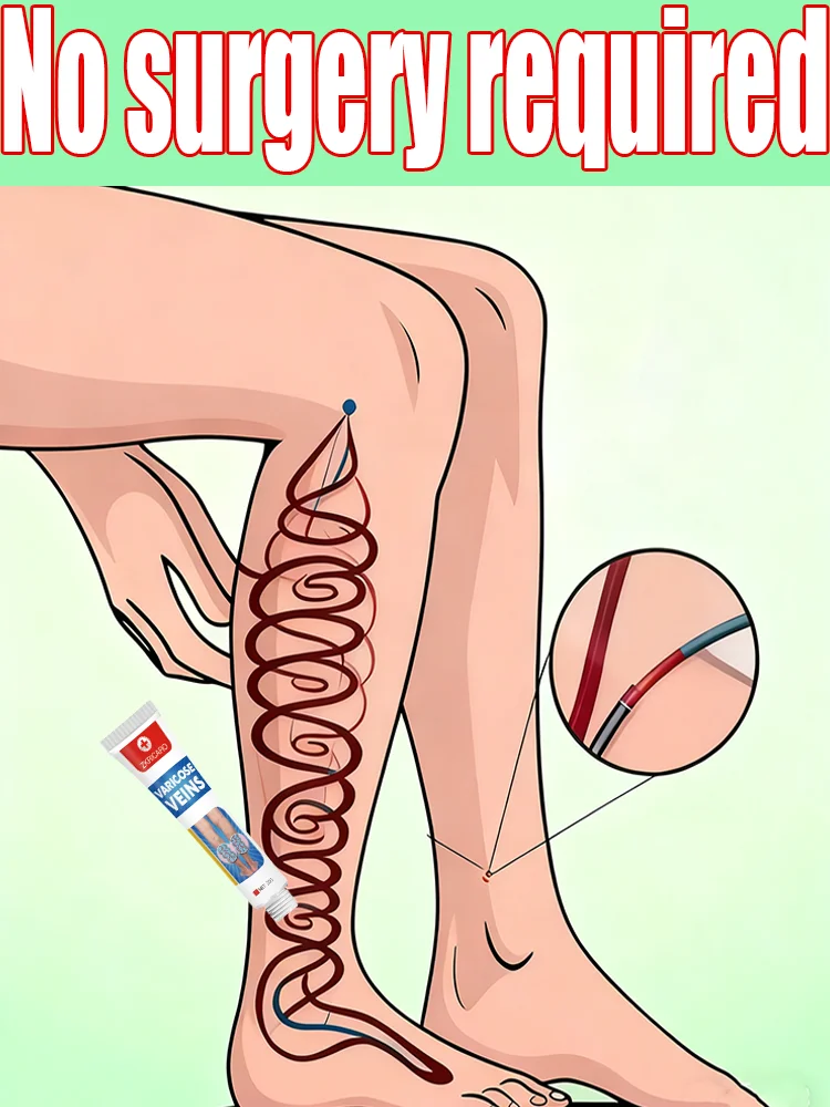 

Rᴏᴄᴋ Sʜᴏʀᴛs Bᴏʟᴅʟʏ: Vᴀʀɪᴄᴏsᴇ Vᴇɪɴ Cʀᴇᴀᴍ ғᴏʀ Vᴇɪɴ Sᴜᴘᴘᴏʀᴛ