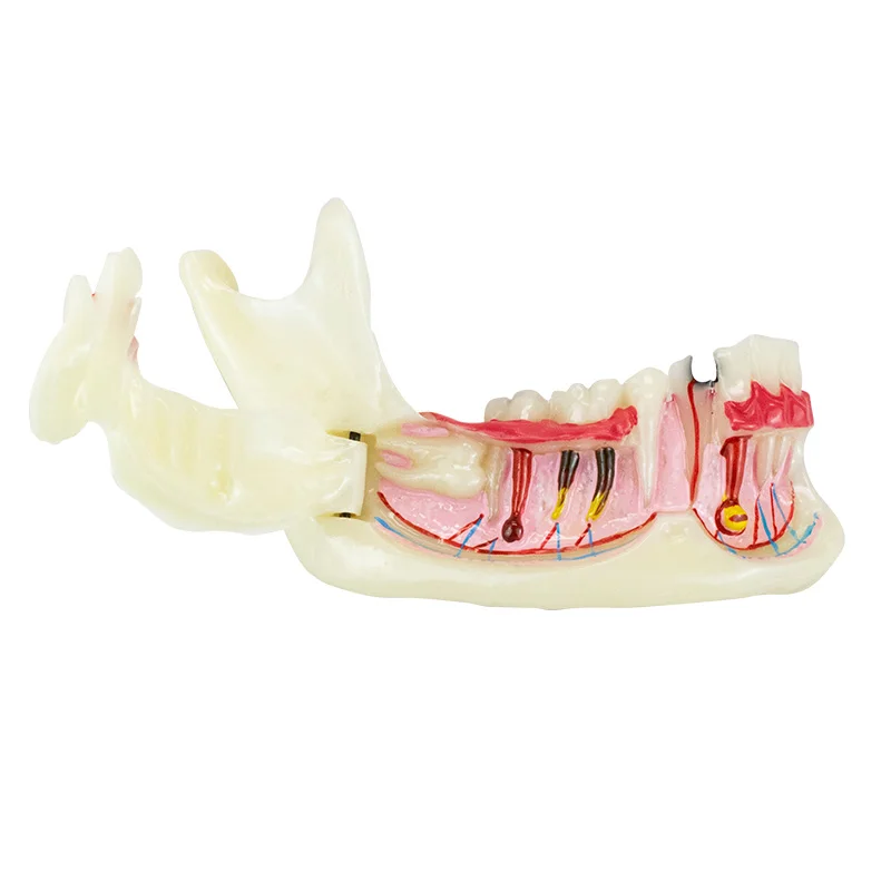 Dental Endodontic Treatment Model Anatomy of Gums Mandible Tissue Anatomical Model Dentist Teach Study Demonstration Teeth Model