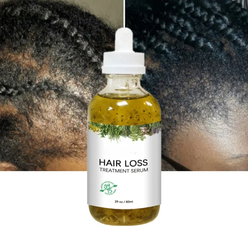 Sérum de croissance rapide des cheveux, repousse de l'élan africain, traction alopécie, prévention de la perte de cheveux, points chauves, huile de traitement des cheveux Thinnin, nouveau